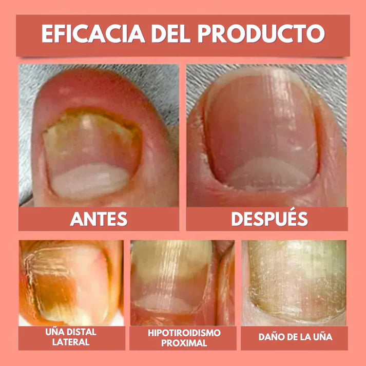 PARCHES ANTIHONGOS PARA UÑAS